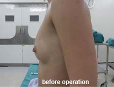plastic-surgery-breast-augmentation 